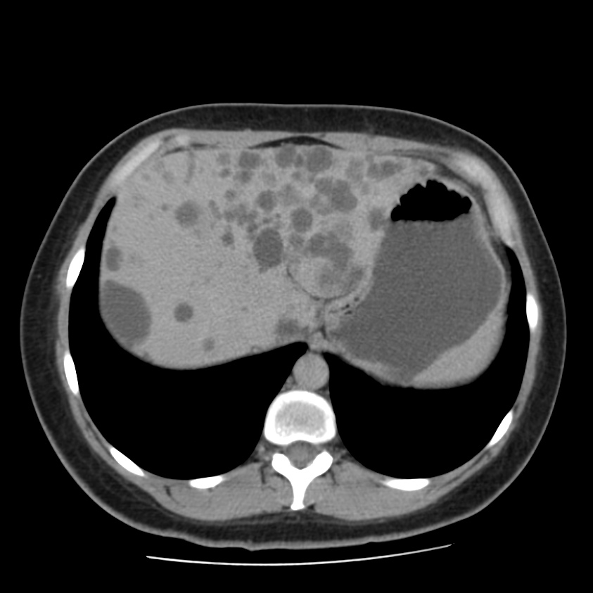 Autosomal dominant polycystic kidney disease (Radiopaedia 23061-23093 C+ delayed 12).jpg