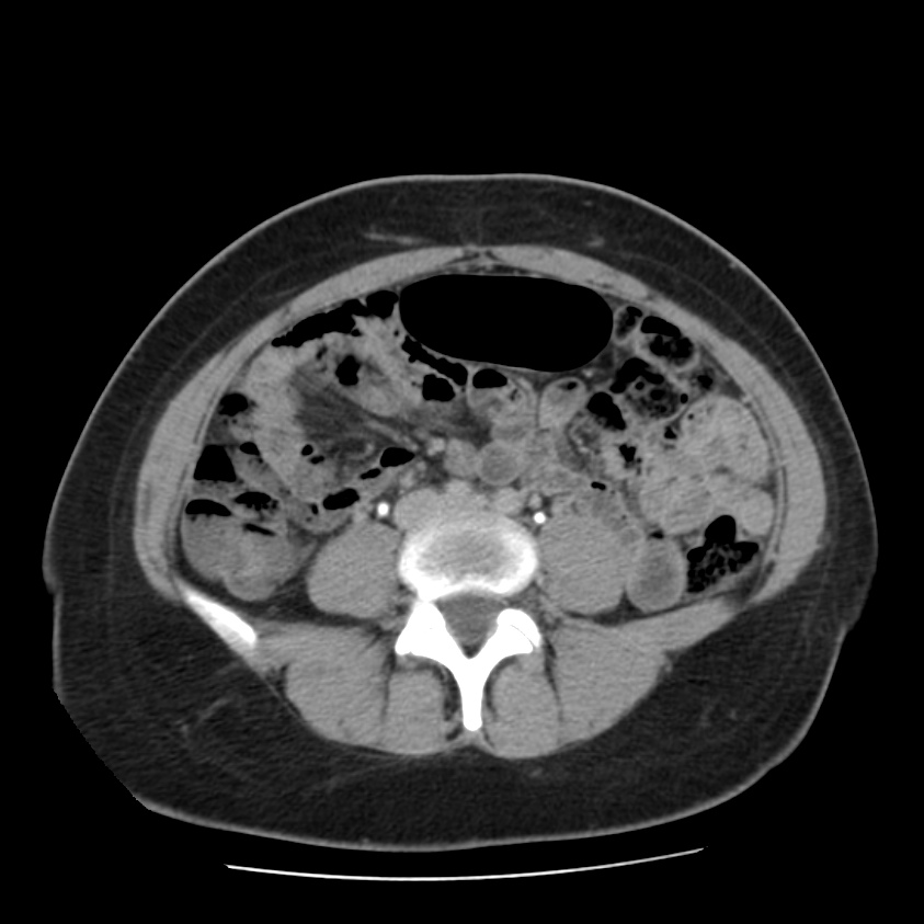 Autosomal dominant polycystic kidney disease (Radiopaedia 23061-23093 C+ delayed 45).jpg
