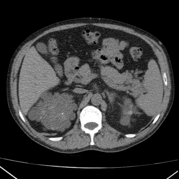 File:Autosomal dominant polycystic kidney disease (Radiopaedia 36539-38101 Axial non-contrast 27).jpg