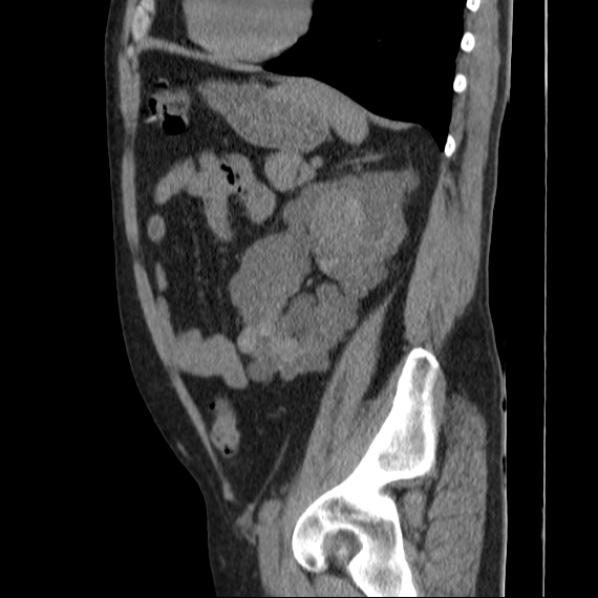 File:Autosomal dominant polycystic kidney disease (Radiopaedia 36539-38101 D 58).jpg