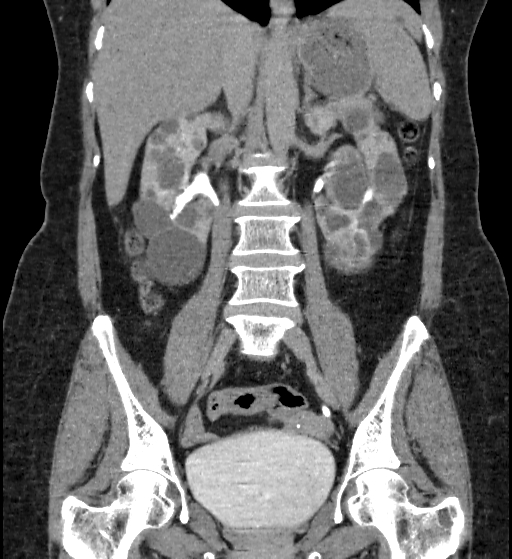 File:Autosomal dominant polycystic kidney disease (Radiopaedia 38189-40194 Coronal C+ delayed 52).jpg