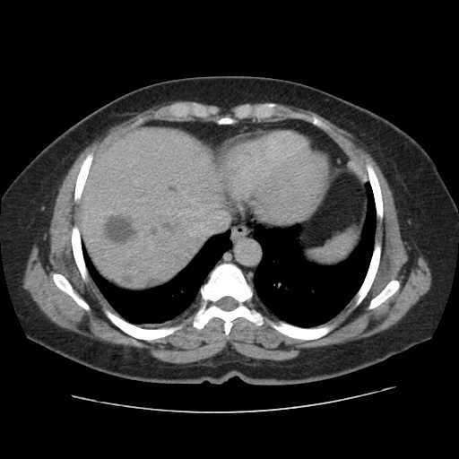 File:Autosomal dominant polycystic kidney disease with hepatic involvement (Radiopaedia 32693-33662 C 7).jpg