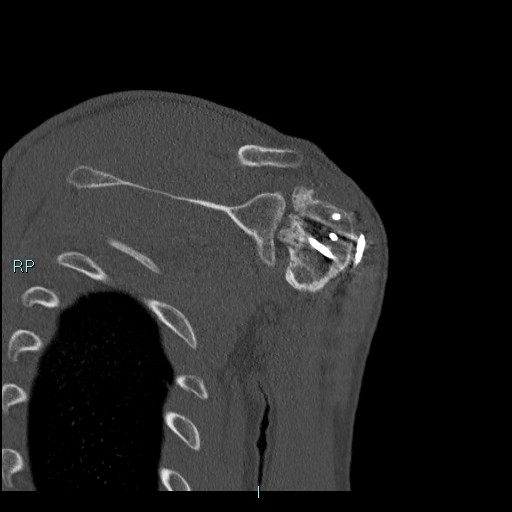 Avascular necrosis after fracture dislocations of the proximal humerus (Radiopaedia 88078-104655 Coronal bone window 89).jpg