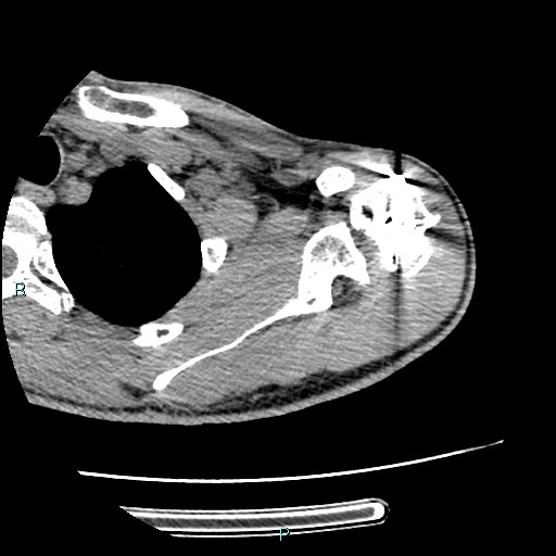 Avascular necrosis after fracture dislocations of the proximal humerus (Radiopaedia 88078-104655 D 42).jpg