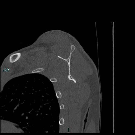Avascular necrosis after fracture dislocations of the proximal humerus (Radiopaedia 88078-104655 Sagittal bone window 48).jpg