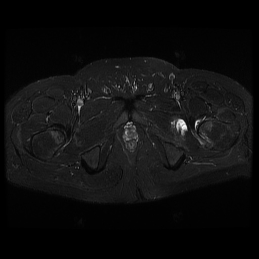 File:Avascular necrosis of the hip (Radiopaedia 61503-69465 Axial STIR 23).jpg