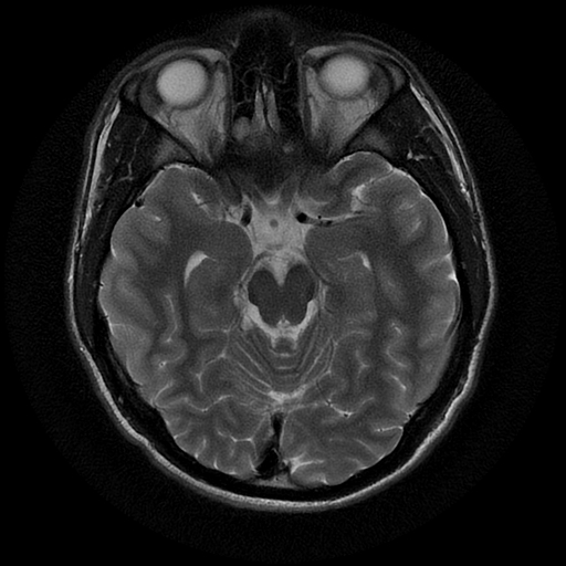 File:Azygos anterior cerebral artery (Radiopaedia 17059-16756 Axial T2 16).jpg