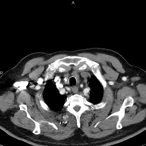 Azygos continuation of the inferior vena cava (Radiopaedia 18537-18404 C+ arterial phase 9).jpg