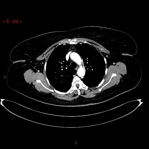 Azygos fissure and lobe (Radiopaedia 47620-52278 A 55).jpg