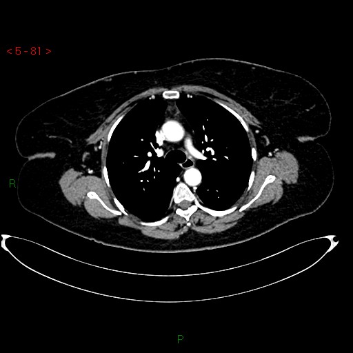 Azygos fissure and lobe (Radiopaedia 47620-52278 A 67).jpg
