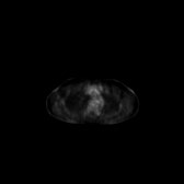 B-cell lymphoma of the mesentery (Radiopaedia 65743-74868 18F-FDG PET-CT 221).jpg