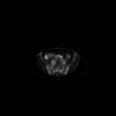 B-cell lymphoma of the mesentery (Radiopaedia 65743-74868 18F-FDG PET-CT 97).jpg