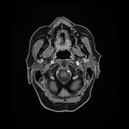 Balo concentric sclerosis (Radiopaedia 53875-59982 Axial LAVA C+ 24).jpg