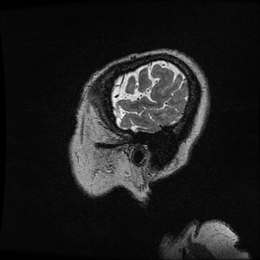 Balo concentric sclerosis (Radiopaedia 53875-59982 Sagittal 3D FSE 268).jpg