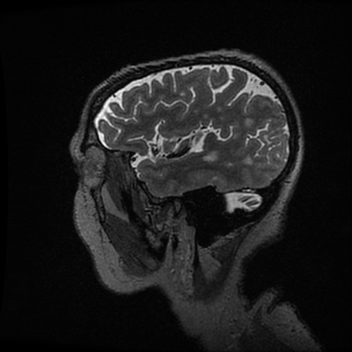 Balo concentric sclerosis (Radiopaedia 53875-59982 Sagittal 3D FSE 52).jpg