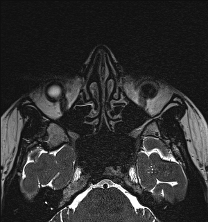 Basal cell carcinoma - nasal region (Radiopaedia 70292-80365 Axial Gradient Echo 53).jpg