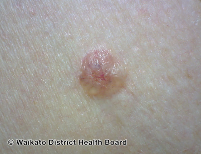 File:Basal cell carcinoma affecting the arms and legs 5 macro (DermNet NZ bcc-5-macro).jpg