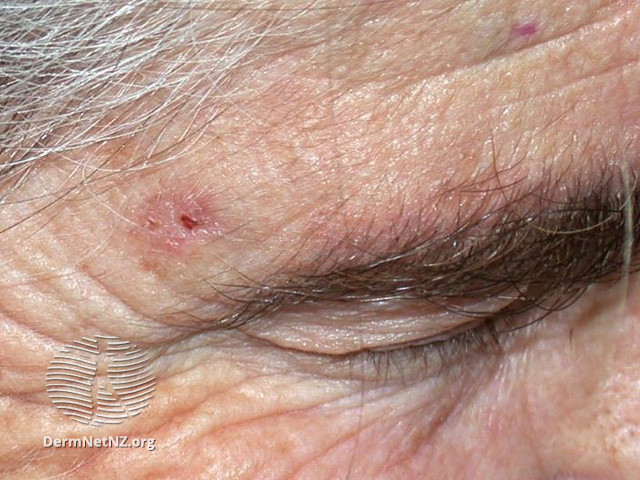 Basal cell carcinoma affecting the face (DermNet NZ lesions-bcc-face-1166).jpg