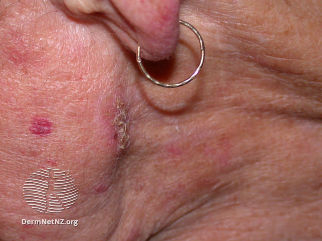 Basal cell carcinoma affecting the face (DermNet NZ lesions-bcc-face-1237).jpg
