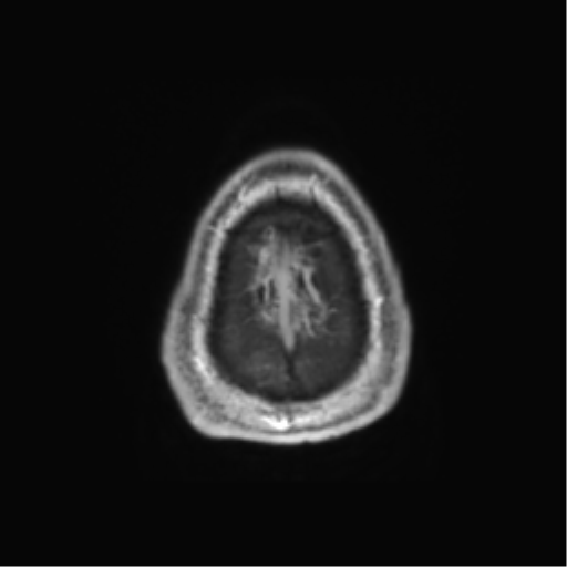 Basal ganglia hemorrhage - hypertensive (Radiopaedia 42227-45303 Axial T1 C+ 143).png