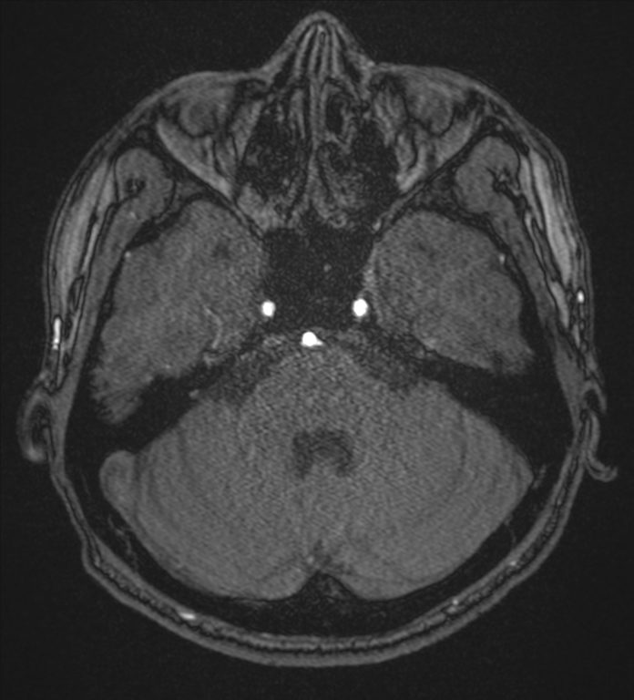 Basal ganglia subacute infarct (Radiopaedia 80201-93521 Axial MRA 21).png