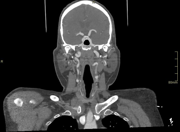 Basilar artery aneurysm (Radiopaedia 56261-62932 B 15).jpg