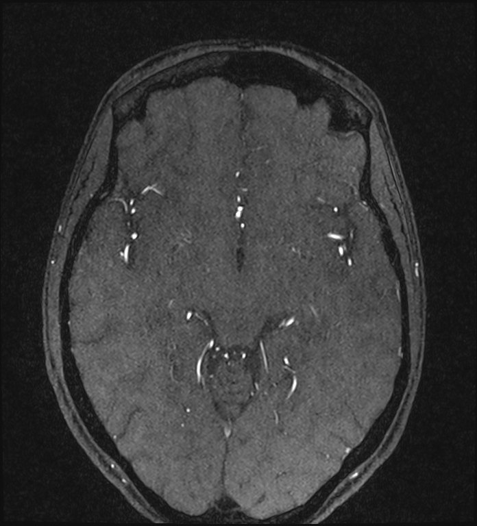 Basilar artery perforator aneurysm (Radiopaedia 82455-97733 Axial MRA 119).jpg