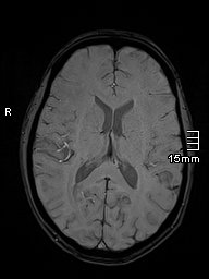 File:Basilar artery perforator aneurysm (Radiopaedia 82455-99523 Axial SWI 38).jpg