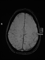 Basilar artery perforator aneurysm (Radiopaedia 82455-99523 Axial SWI 51).jpg