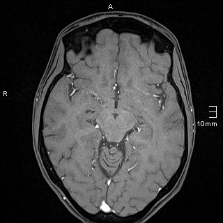 Basilar artery perforator aneurysm (Radiopaedia 82455-99523 F 63).jpg