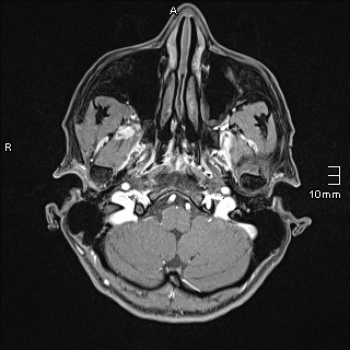 Basilar artery perforator aneurysm (Radiopaedia 82455-99523 G 8).jpg