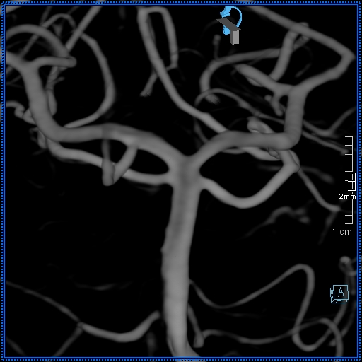 File:Basilar artery perforator aneurysm (Radiopaedia 82455-99524 3D Left VA 46).jpg