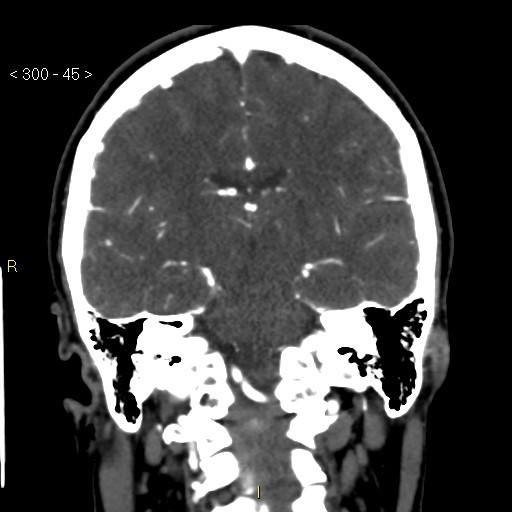 File:Basilar artery thrombosis (Radiopaedia 16260-15944 B 36).jpg