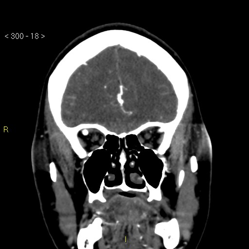 Basilar artery thrombosis (Radiopaedia 16260-15944 B 9).jpg