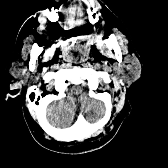 Basilar artery thrombosis (Radiopaedia 53351-59333 Axial non-contrast 19).jpg