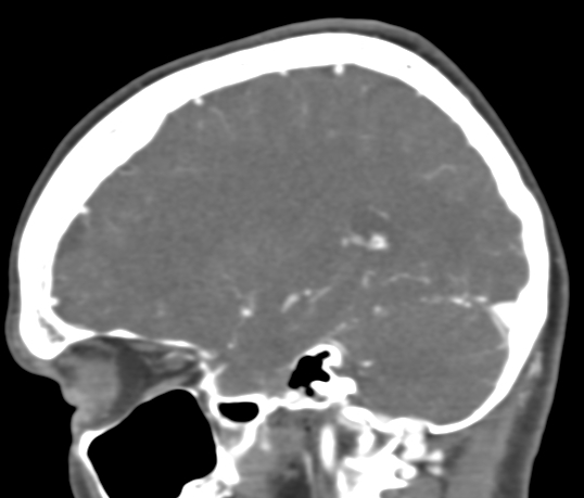 Basilar tip aneurysm with coiling (Radiopaedia 53912-60086 C 41).jpg