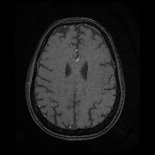 Basilar top and left middle cerebral artery aneurysm (Radiopaedia 61965-70031 Axial MRA 120).jpg