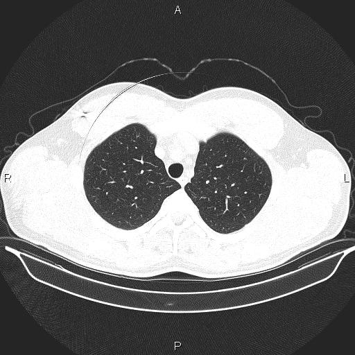 Beam hardening and ring artifacts (Radiopaedia 85323-100915 Axial lung window 20).jpg