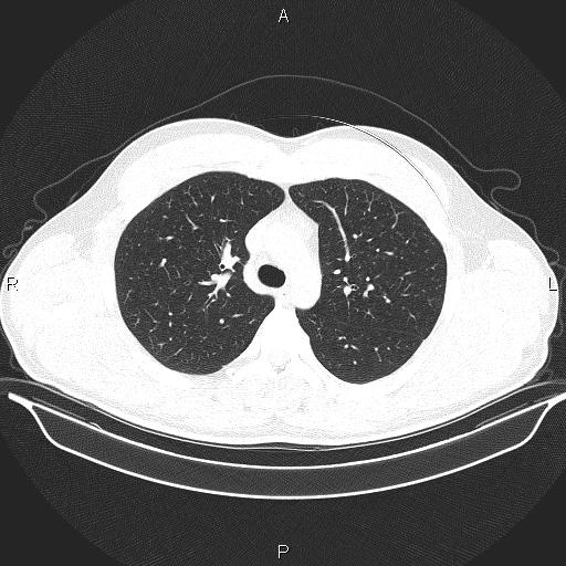Beam hardening and ring artifacts (Radiopaedia 85323-100915 Axial lung window 27).jpg
