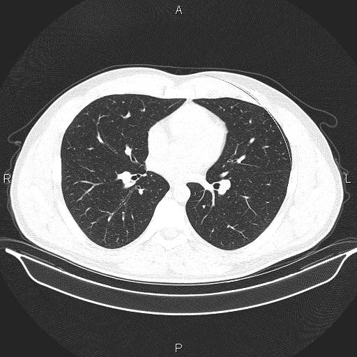 Beam hardening and ring artifacts (Radiopaedia 85323-100915 Axial lung window 42).jpg