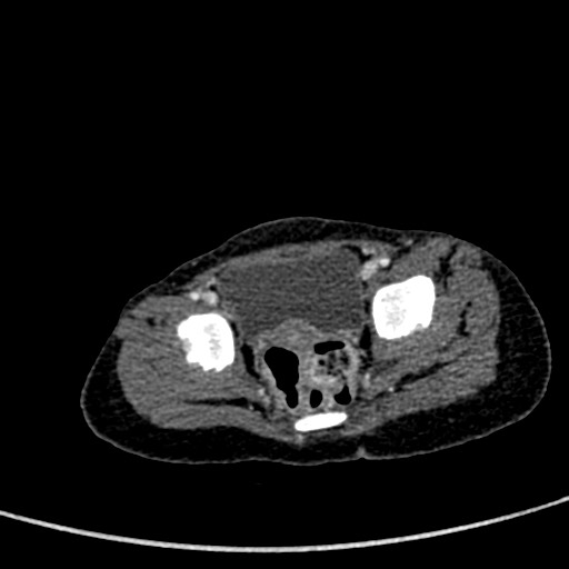 File:Beckwith-Wiedeman syndrome with bilateral Wilms tumors (Radiopaedia 60850-68629 A 99).jpg