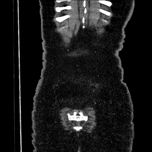 File:Benign leiomyoma with hydropic features (Radiopaedia 89250-106130 B 104).jpg