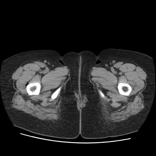 File:Bicornuate uterus- on MRI (Radiopaedia 49206-54296 Axial non-contrast 19).jpg