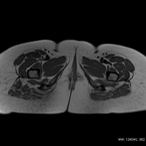 File:Bicornuate uterus- on MRI (Radiopaedia 49206-54297 Axial T1 19).jpg