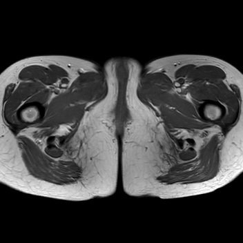 File:Bicornuate uterus (Radiopaedia 61974-70046 Axial T1 46).jpg