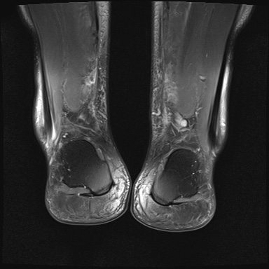 File:Bilateral Achilles tendon complete tear (Radiopaedia 81344-95051 Coronal PD fat sat 3).jpg