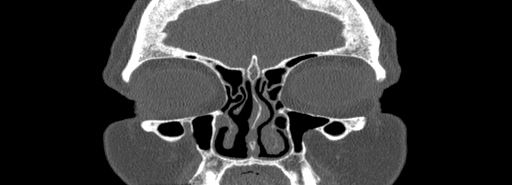 Bilateral Ectopic Infraorbital Nerves (Radiopaedia 49006-54084 Coronal bone window 13).jpg