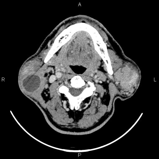 Bilateral Warthin tumors (Radiopaedia 84034-99263 Axial With contrast 29).jpg