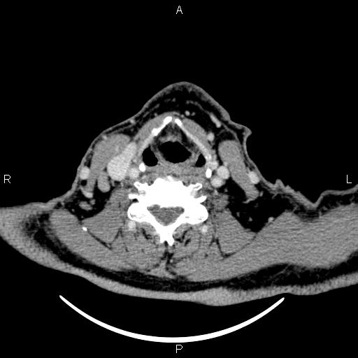 File:Bilateral Warthin tumors (Radiopaedia 84034-99263 Axial With contrast 43).jpg