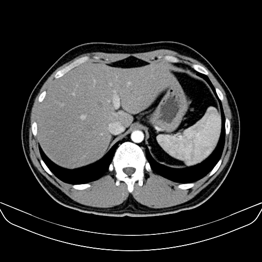 Bilateral accessory renal arteries with mild pelvi-ureteric junction (PUJ) obstruction (Radiopaedia 66357-75596 A 7).jpg